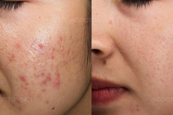 Acne Treatment