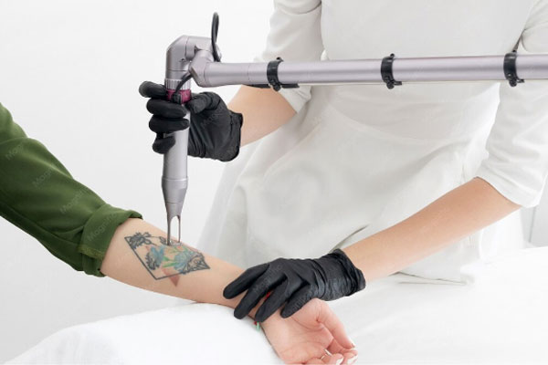Laser Tatto Removal