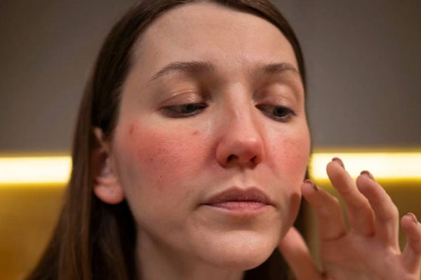Skin Pigmentation