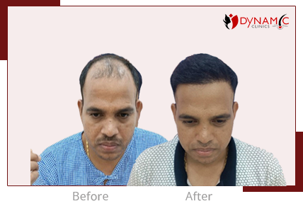 After Before