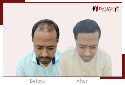 After Before