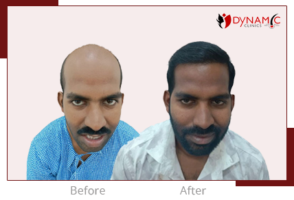 After Before