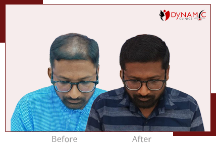 After Before